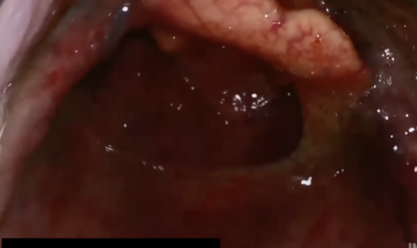 First-Pass Intubation | Mucous & Fluid Obstruction