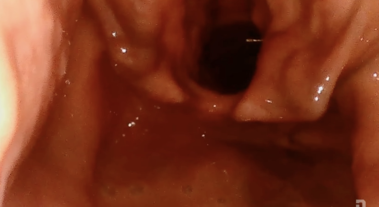 Bougie-First Intubation | Direct Cord Visualization