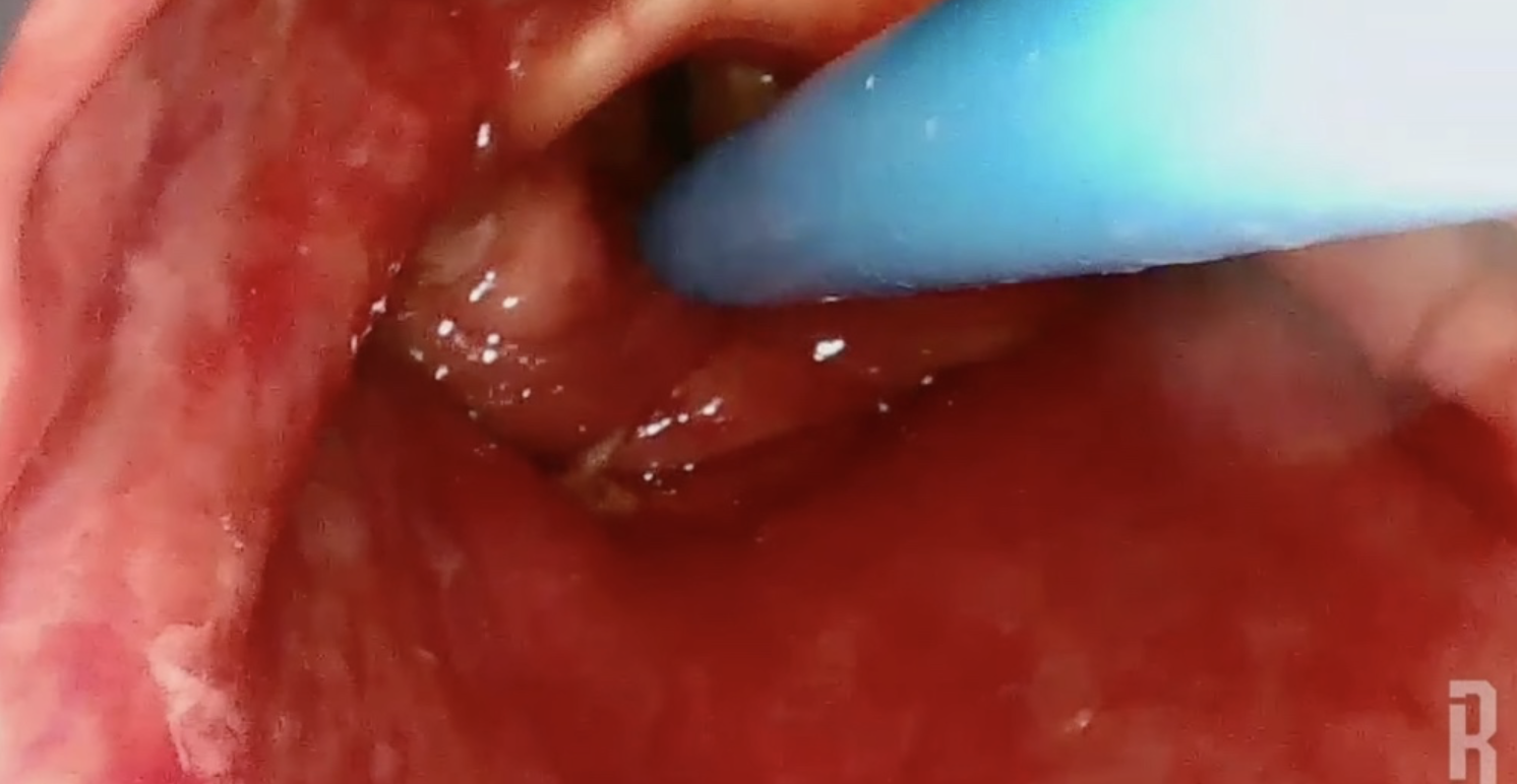 Bougie-First Intubation | Airway Edema Case Review